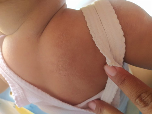 Kering di kulit bayi