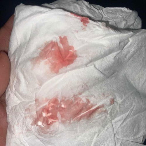 Flek saat hamil 4week