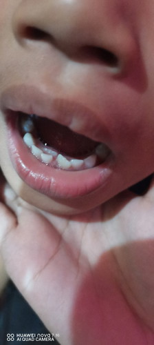 Wait ko po ba kusang matanggal yung nasa harap (temporary teeth) in my 5 yr old?