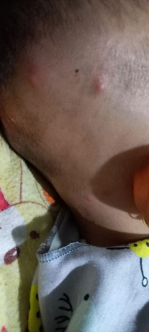 Bisul bernanah di kepala bayi 2,5 bulan