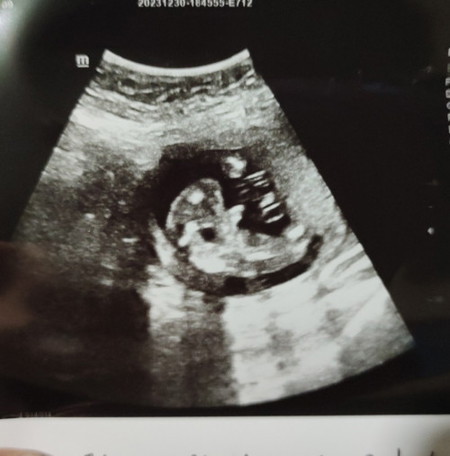 Gender baby