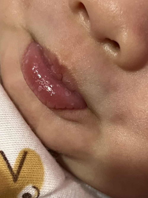 ตรงปากน้องเป็นแผลร้อนในหรือป่าวคะ น้องไม่มีอาการเจ็บดูดนมได้ปกติค่ะ