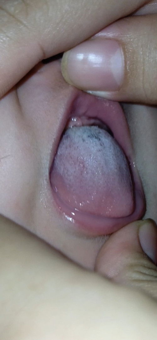 Jamur hitam di lidah bayi