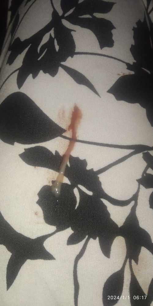 Flek karena kecapean