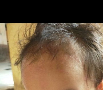 Beruntusan dijidat dan area kepala