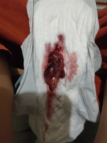 Miscarriage or blood clot lang