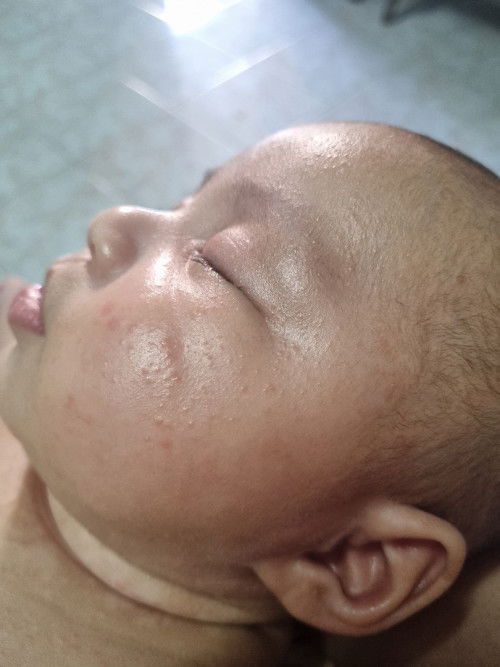 สอบถามหน่อยค่าเด็กเม็ดเล็กเต็มหน้าเพราะอะไร