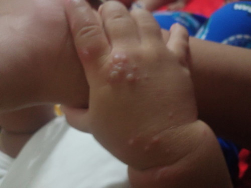 chickenpox?