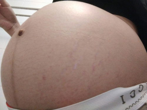 ท้องแตกลาย