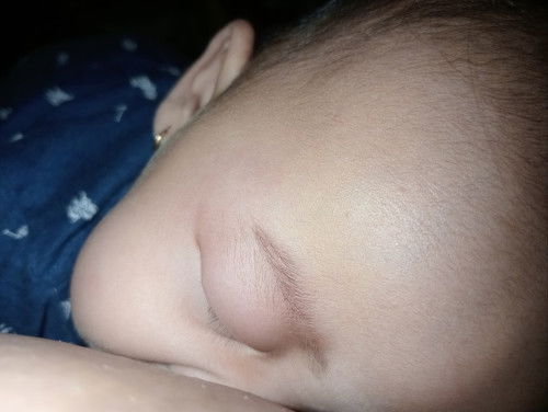 Mata anak bengkak bekas di gigit nyamuk