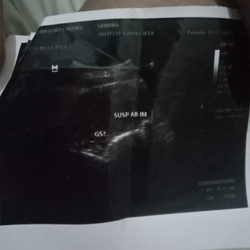 Sudah keluar jaringan dan daging,waktu di usg masih ada janin?