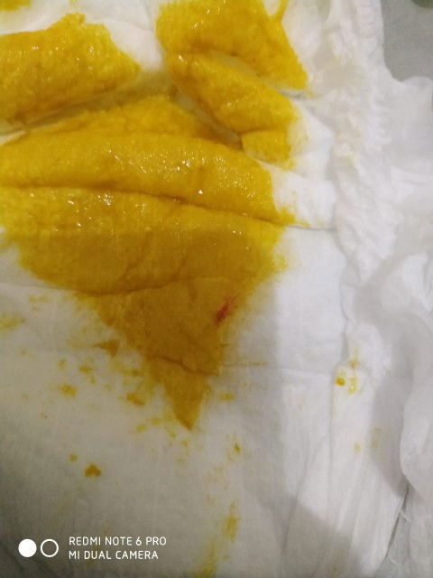 Bayi 4 bulan BAB ada darahnya