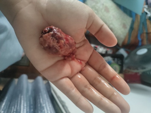 Ketulan besar