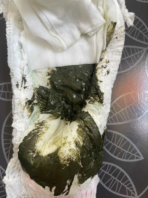 อึสีเขียวเข้ม ลักษณะเหนียวๆ แบบนี้ปกติไหม