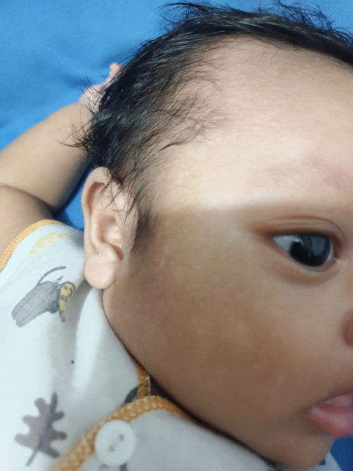 Putih- putih di wajah Bayi