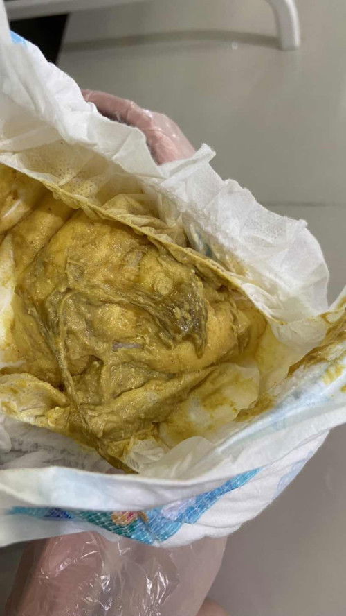 อึลูกเป็นสีเหลืองอ่อนแบบนี้ปกติไหมคะ?