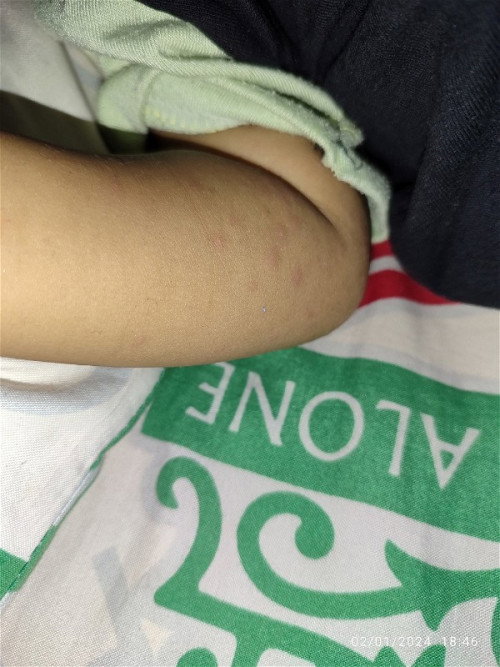 Bintik merah pada bayi