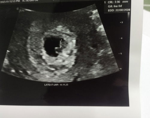 Adakah saya pregnant twin?