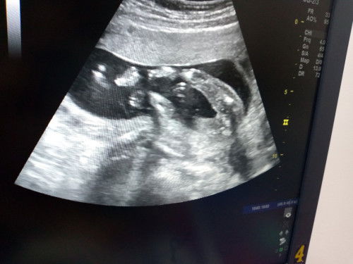 เเบบผู้หญิงไหมคะท้อง2ค่ะ
20w2b