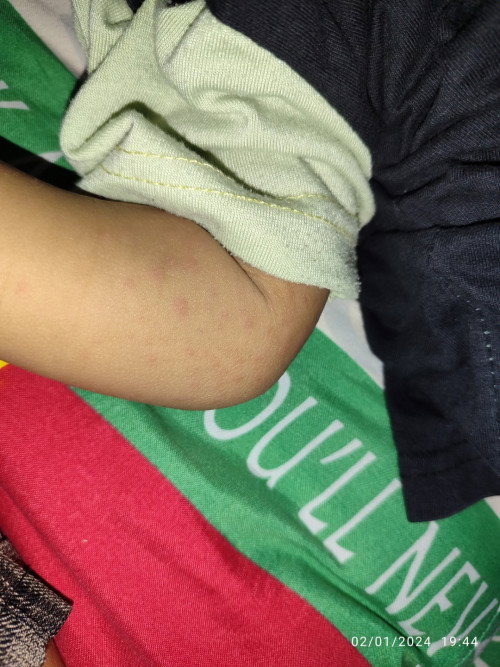 Bintik Merah Pada Bayi
