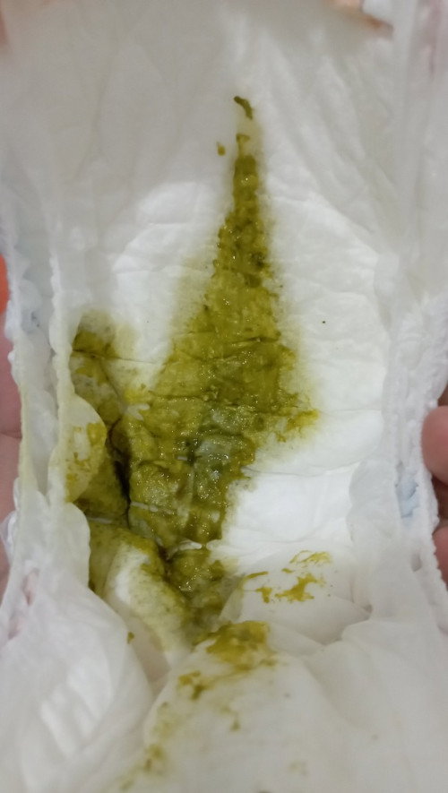 Diare anak 5 bulan 23 hari