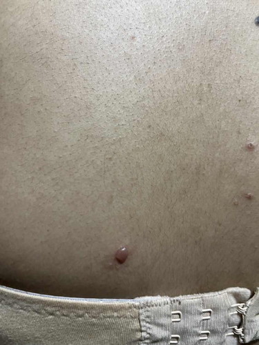 8 weeks napo ako tapus may mga tumutubo sa katwan k prang pimples na may tubig ano po gamot