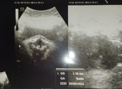 Flek selama 6 hari. Gs:1,18cm Hamil 5minggu, ke dokter kandungan katanya harus dikuret. Ank pertam.