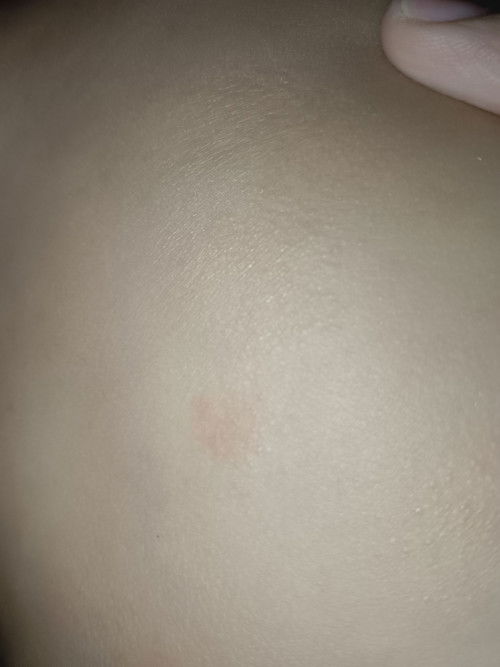 Ini biang keringat atau efek bawang merah?