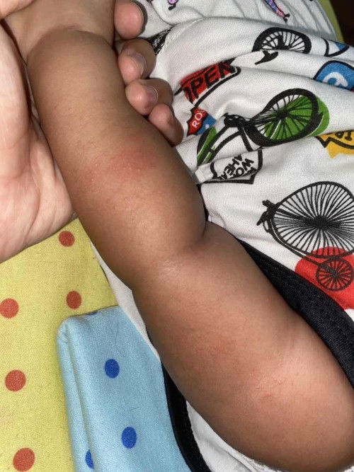 Beruntusan pada tangan dan kaki bayi??