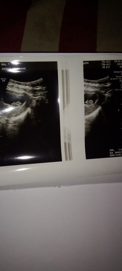 Baru sempat USG di umur 8w4d