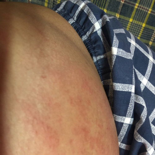 ผื่นคันค่ะกังวนมาก