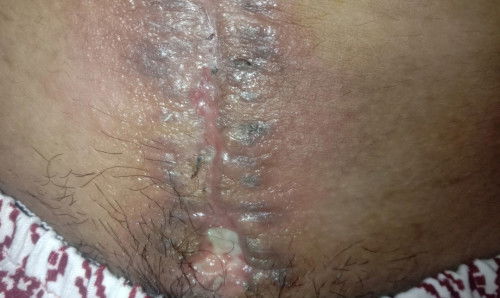 Update sa CS case ko po..