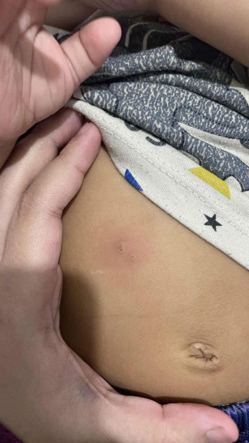 Bintik merah titik hitam pada bayi