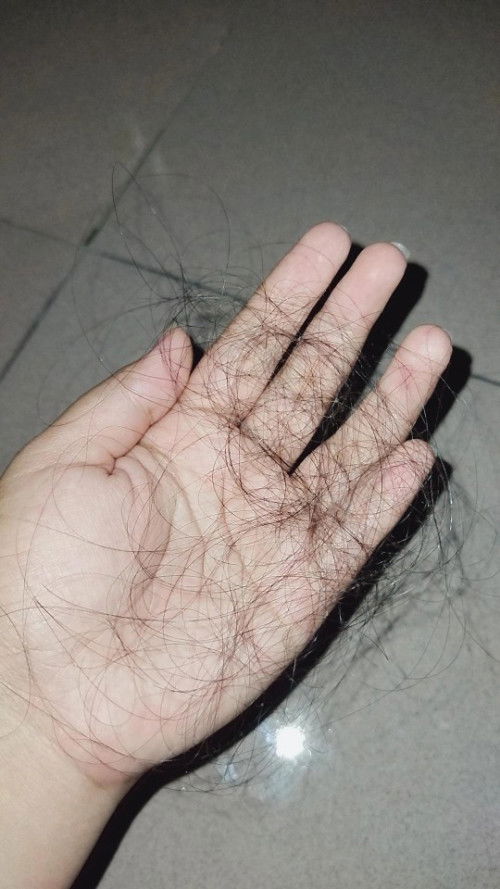 POSTPARTUM HAIR LOSS