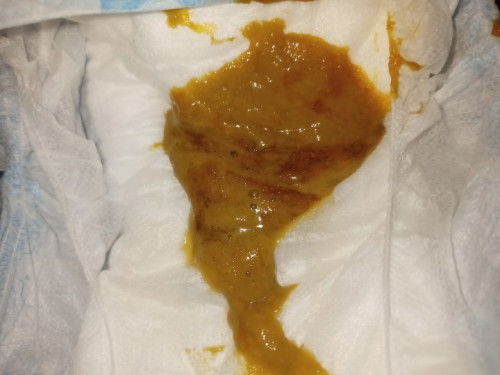 Normal lang Po ba to ganitong poop ni baby po