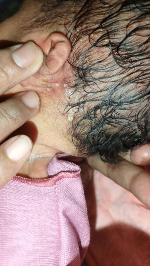 Ada Nanah dikuping dan ketiak