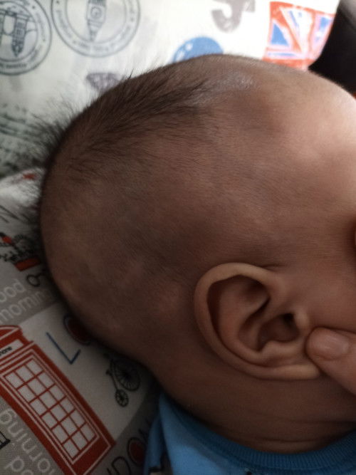 Blentong2 di Kulit Kepqlq Bayi