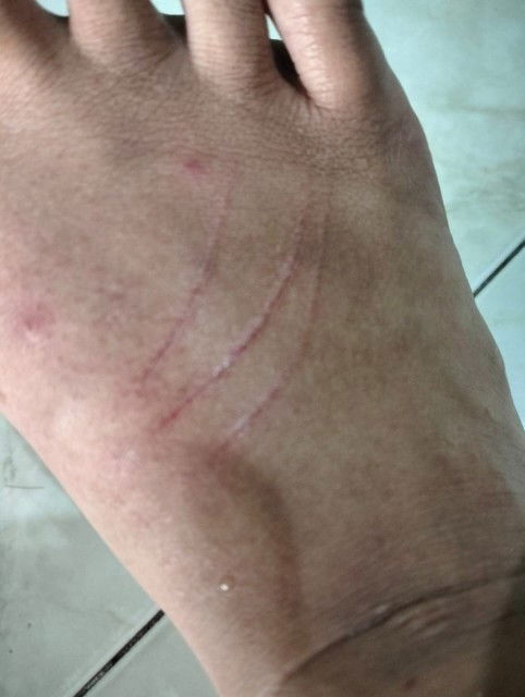 Dicakar tikus usia 37 Weeks