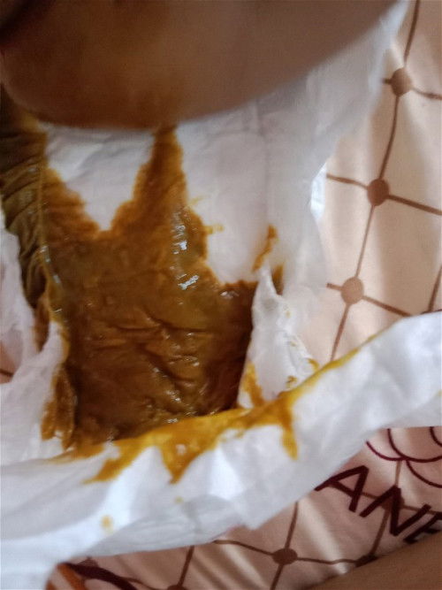 อึลูกสรเขียวขีม้าเป้นนํ้าเหลว