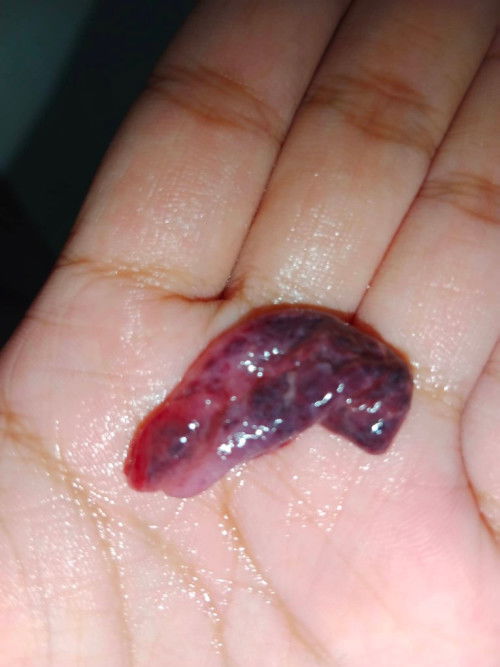 Miscarriage/menstruation