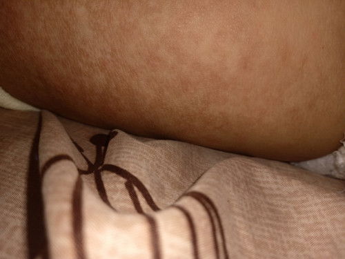 Bayi umur 14 bulan kulit sepertti ini