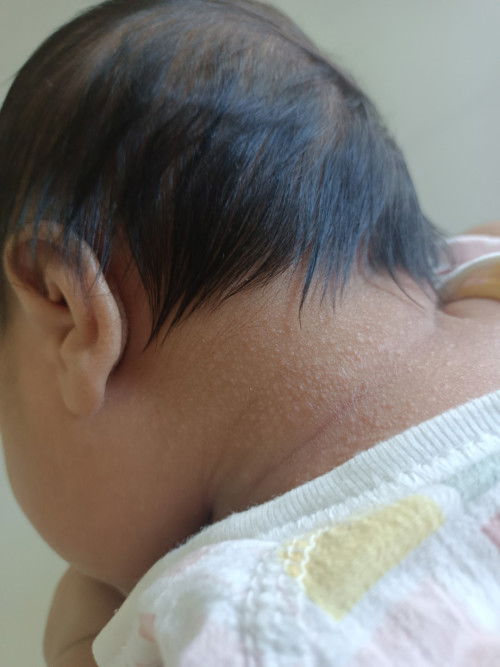 ผื่นแพ้ หรือ กลากน้ำนม