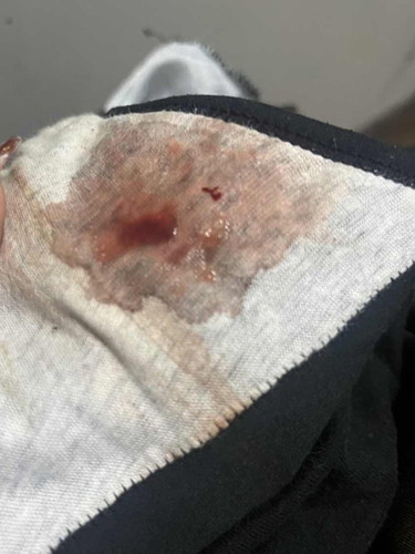 Menstruation like bleeding on my 4th week & 5 days pregnancy. May fake pregnancy po ba?