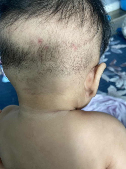 bintik merah dan gatal