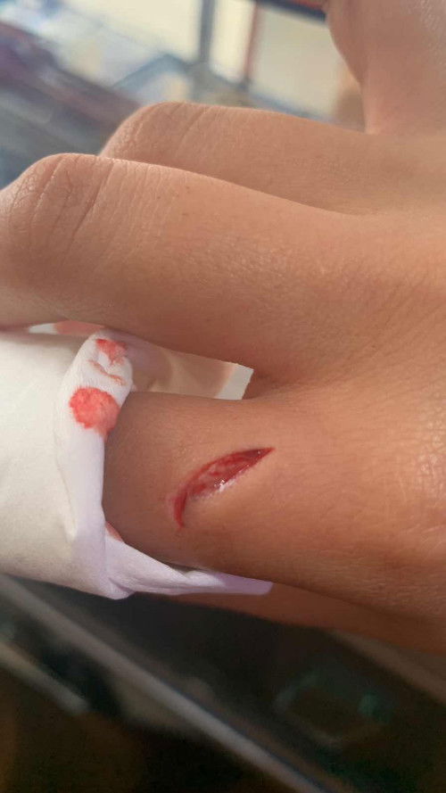 luka di bagian tangan