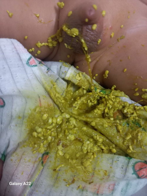 Phân bé hột hột như z là do nguyên nhân gì vậy ạ mong các mom giúp e với