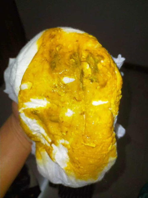 ขอสอบถามหน่อยค่ะ ถ้าอึแบบนี้ปกติมั้ย