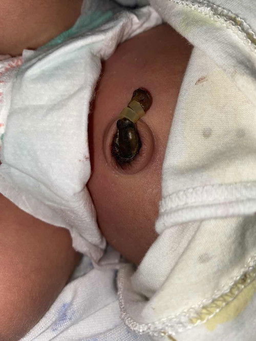 น้อง9วัน สะดือมีเลือดออกรอบๆสะดือ แบบนี้ปกติไหมคะ ต้องไปหาหมอมั้ยคะ