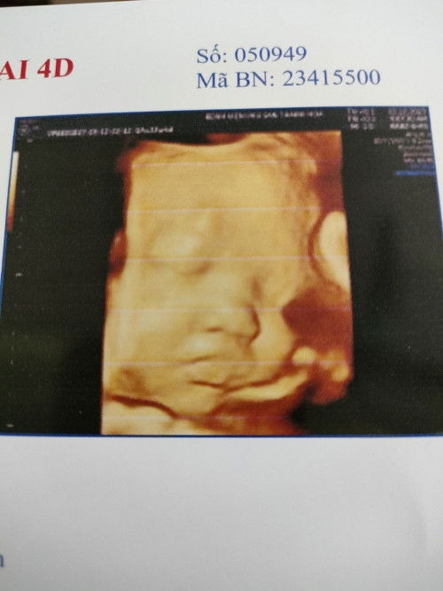 Bầu bé gái 35tuần 2 ngày  bé được 3.2kg