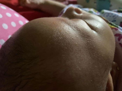 Bayi biang keringat/beruntusan